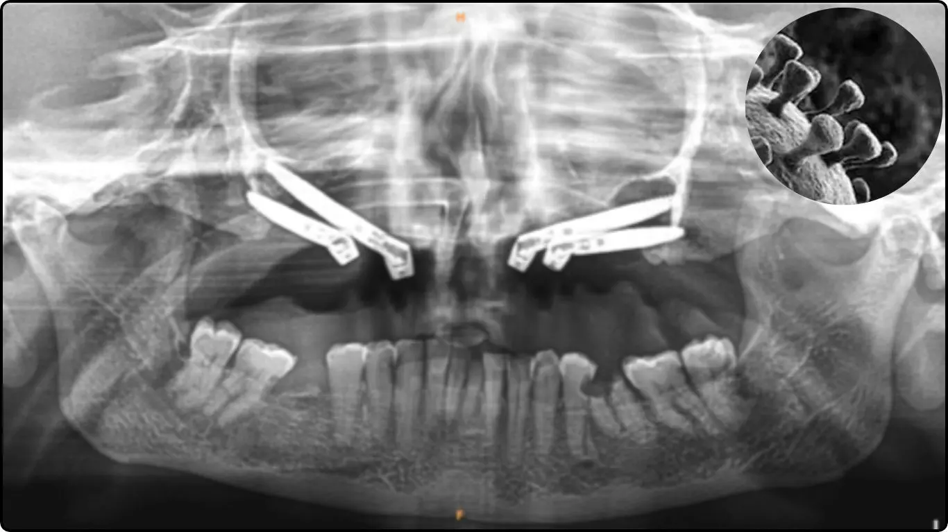 black fungus surgery in AIIMS Bhopal black fungus surgery in AIIMS Bhopal