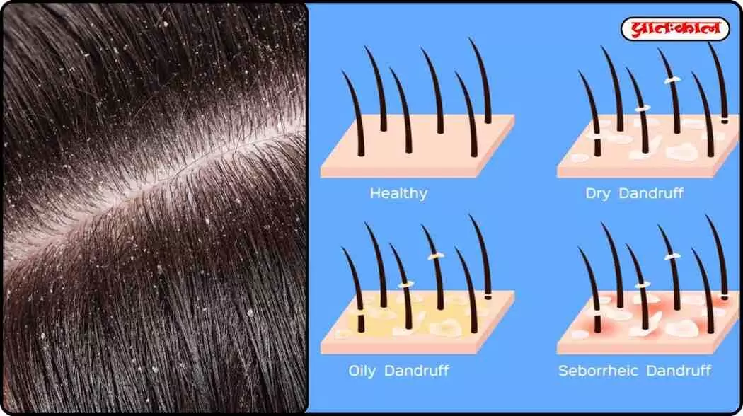 Control dandruff with home remedies; natural ingredients will strengthen your hair from the roots. Control dandruff with home remedies; natural ingredients will strengthen your hair from the roots.