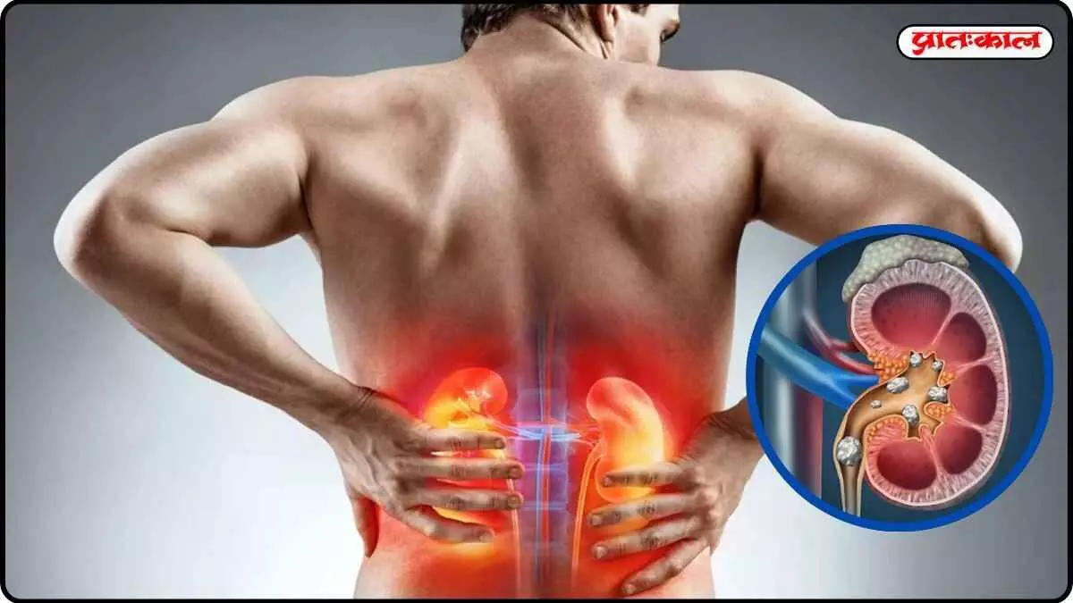 How harmful are kidney stones? Learn about the treatments to prevent them. How harmful are kidney stones? Learn about the treatments to prevent them.