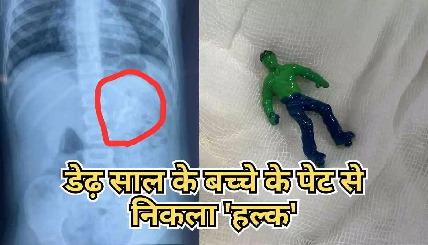 डेढ़ साल के बच्चे ने निगला हल्क,  45 मिनट की जद्दोजहद से सुरक्षित निकाला गया फंसा हुआ हल्क
