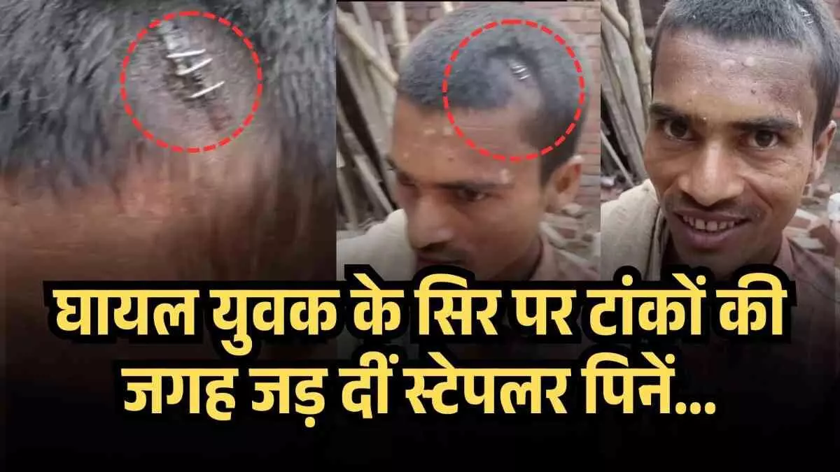 घायल युवक के सिर पर टांकों की जगह जड़ दीं स्टेपलर पिनें... घायल युवक के सिर पर टांकों की जगह जड़ दीं स्टेपलर पिनें...
