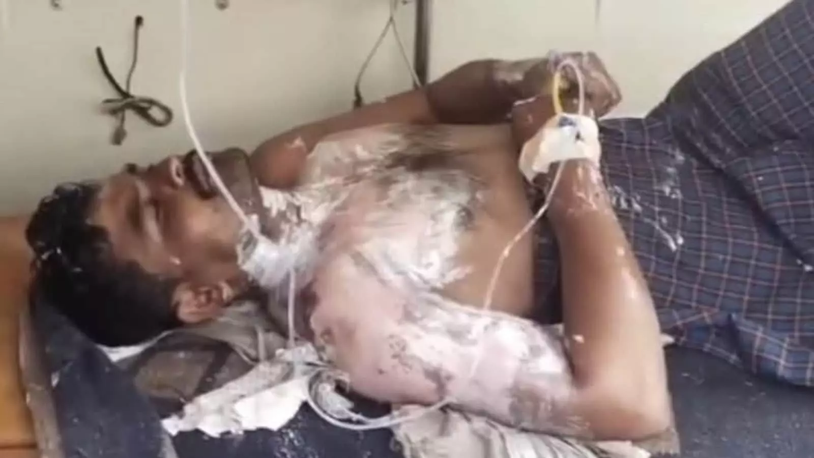 मुरुड में एंबुलेंस खराब होने के बाद स्ट्रेचर पर लेटा हुआ घायल मरीज जिसे इलाज के लिए लातूर ले जाया जा रहा है। मुरुड में एंबुलेंस खराब होने के बाद स्ट्रेचर पर लेटा हुआ घायल मरीज जिसे इलाज के लिए लातूर ले जाया जा रहा है।