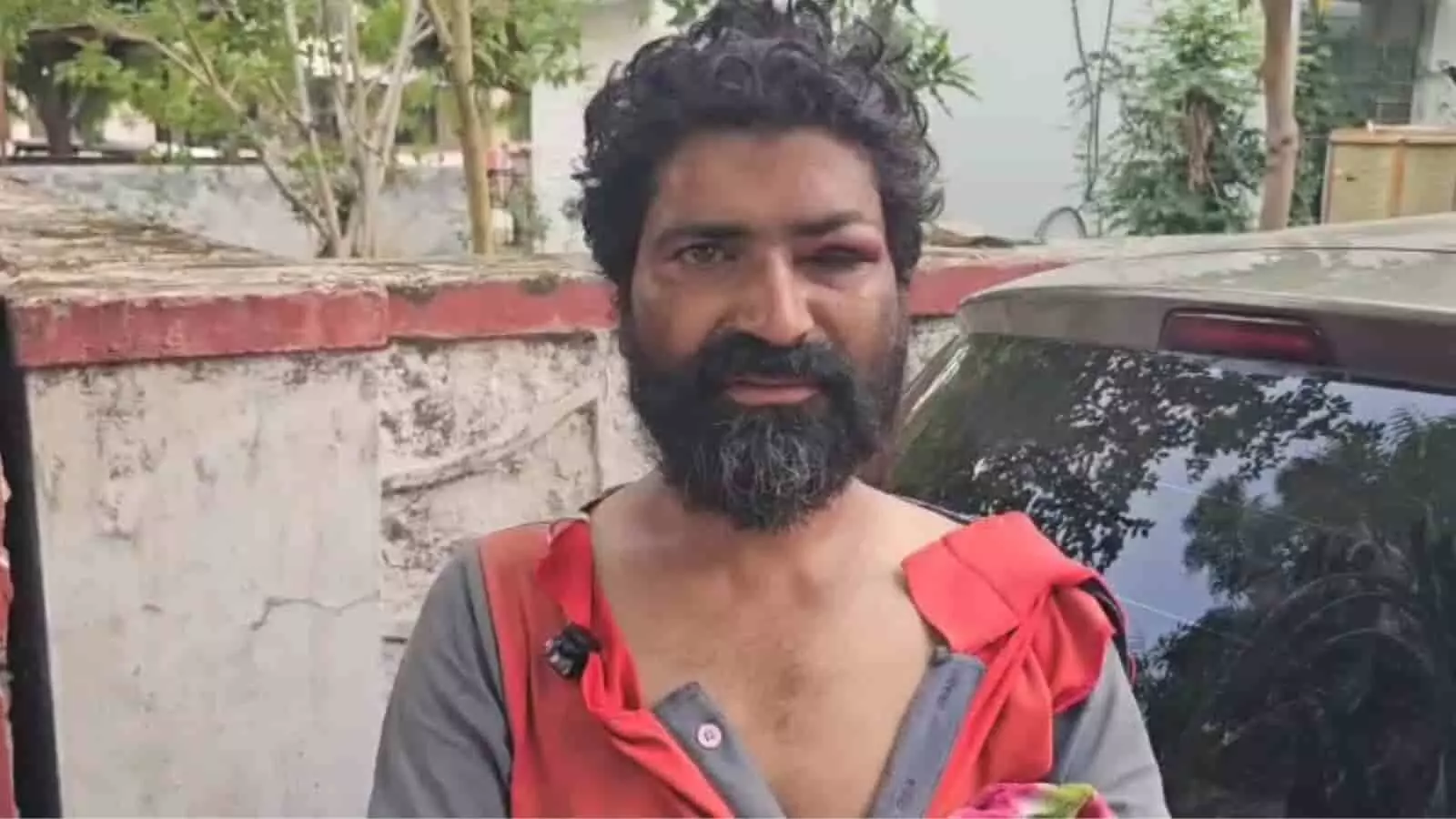 तस्वीर में पीड़ित किसान किशन भील दिखाई दे रहे हैं, जिनकी आंख के पास चोट लगी है। तस्वीर में पीड़ित किसान किशन भील दिखाई दे रहे हैं, जिनकी आंख के पास चोट लगी है।