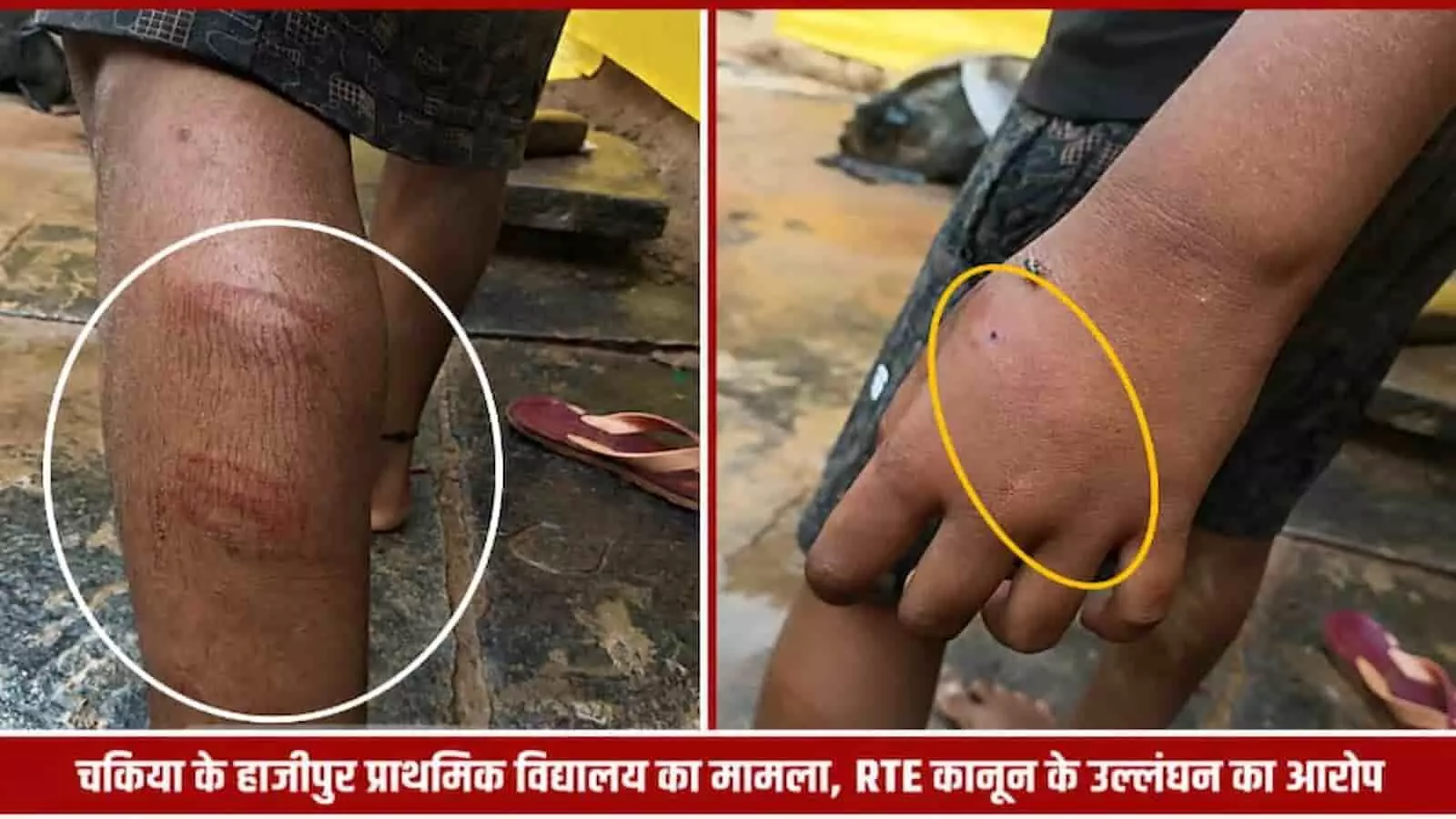 तस्वीर में बच्चे के पैर और हाथ पर लाल रंग के चोट के निशान दिखाई दे रहे हैं। तस्वीर में बच्चे के पैर और हाथ पर लाल रंग के चोट के निशान दिखाई दे रहे हैं।