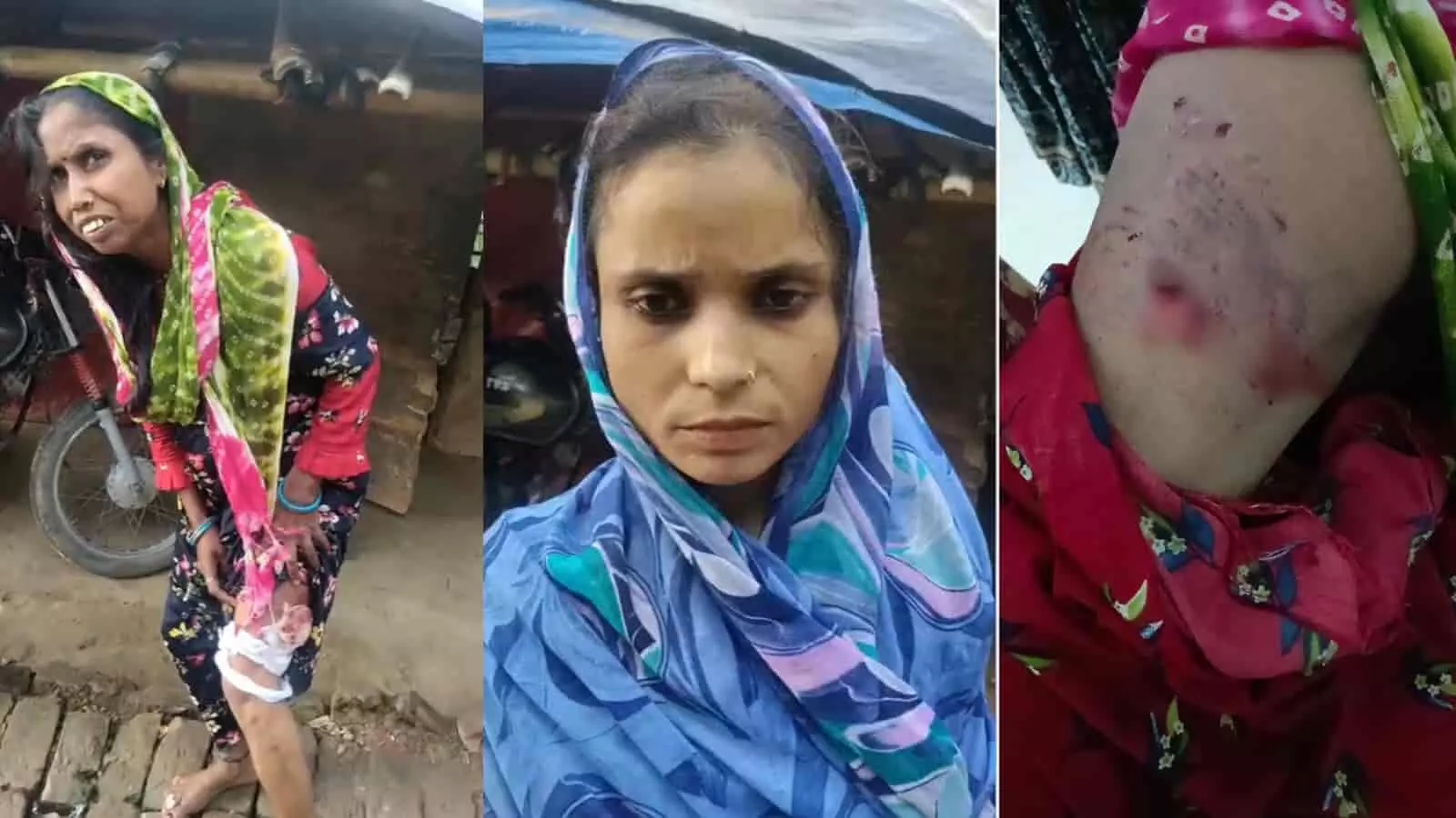 तस्वीर में दो महिलाएं और पैर पर चोट के निशान दिखाई दे रहे हैं। तस्वीर में दो महिलाएं और पैर पर चोट के निशान दिखाई दे रहे हैं।