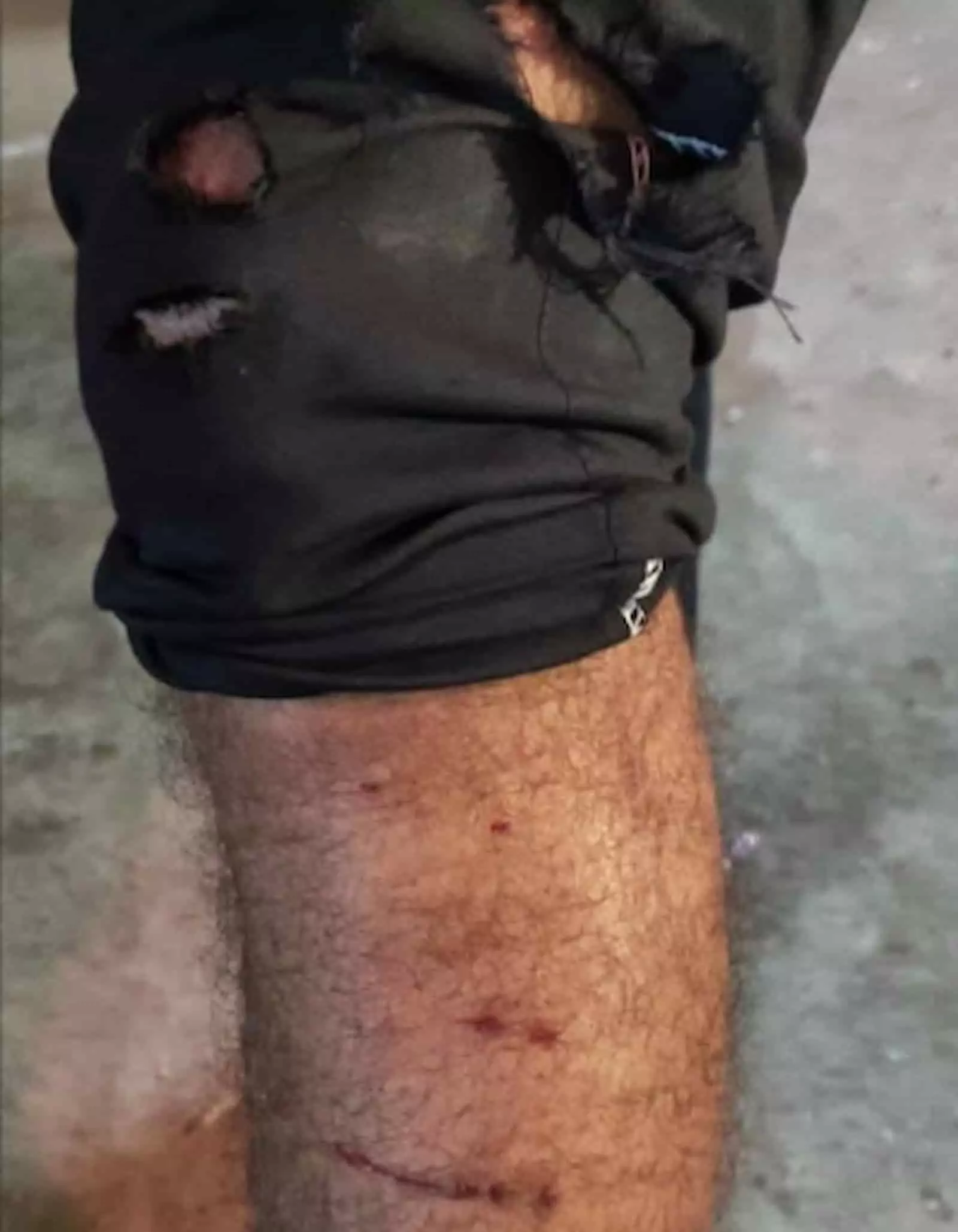 तस्वीर में पैंथर के हमले में घायल हुए व्यक्ति के पैर पर लगी खरोंच और चोट दिख रही है। तस्वीर में पैंथर के हमले में घायल हुए व्यक्ति के पैर पर लगी खरोंच और चोट दिख रही है।