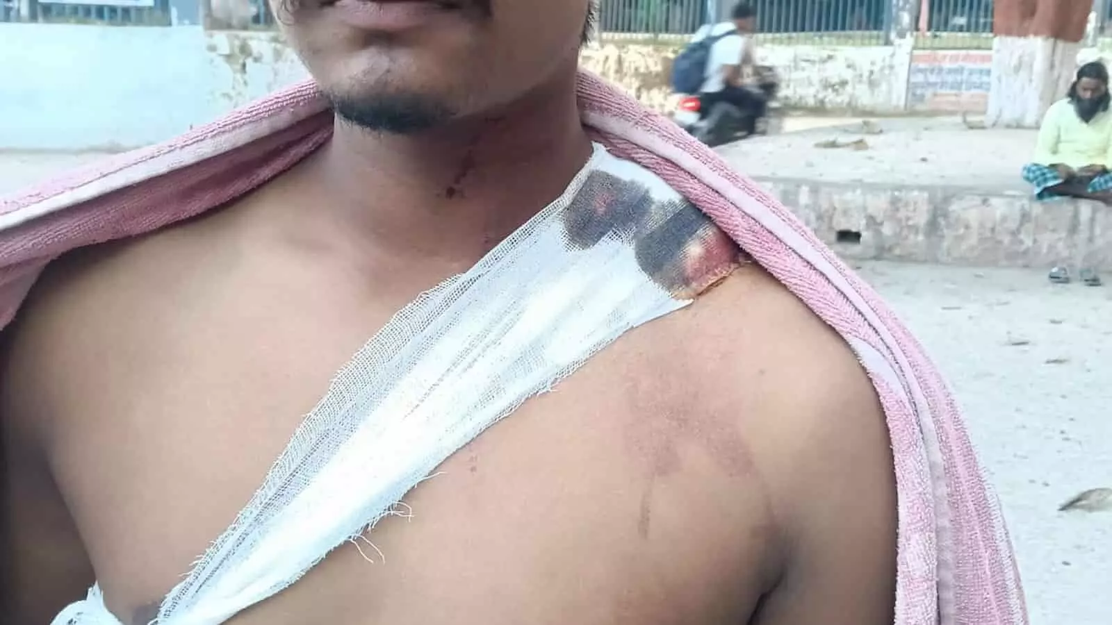 तस्वीर में दिख रही घायल युवक की कंधे की पट्टी, जिस पर सुल्तानगंज फोरलेन पर अपराधियों ने गोली चलाई थी तस्वीर में दिख रही घायल युवक की कंधे की पट्टी, जिस पर सुल्तानगंज फोरलेन पर अपराधियों ने गोली चलाई थी